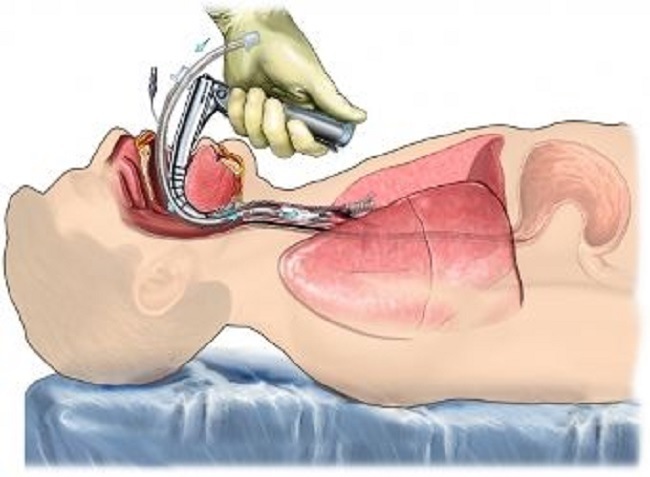 intubation